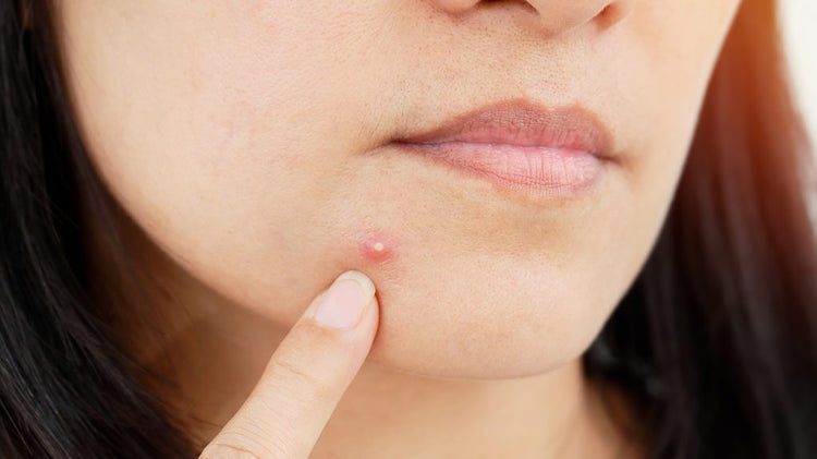 Acne Prevention by Nikua Skin Care